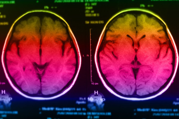 Color-enhanced MRI scan of a human brain showing two symmetrical cross-sectional images with detailed neural structures.